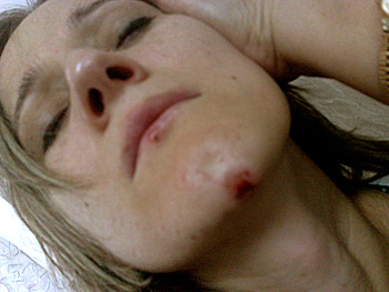 Sapiyat Magomedova after beating. Photo provided by the Human Rights Centre "Memorial"