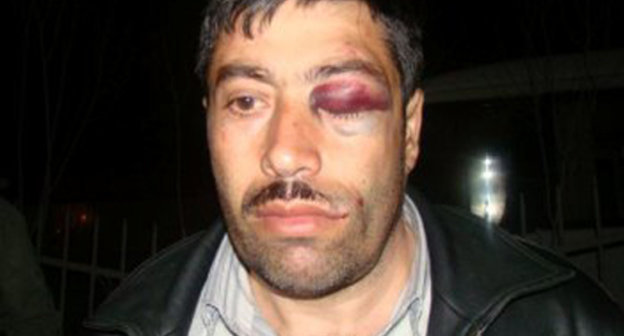 Tazakhan Miralamli after beating at the Yasamal District Police Division. Azerbaijan. Courtesy of the "Azadlyg" (Freedom) newspaper