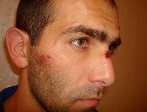 Malik Appaev with traces of beatings on his face, after release from the Elbrus ROVD (District Interior Division). Photo from the website of the Human Rights Centre "Memorial" (www.memo.ru)