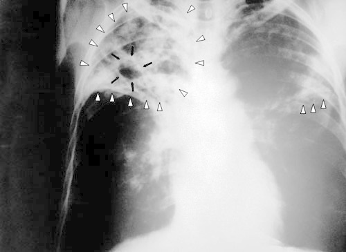 X-ray image of TB patient. Photo by http://ru.wikipedia.org
